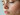 sebum acne