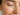 when does acne stop