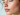 why do people get acne
