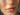stress acne