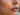 climate acne